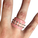 Ring تقويم الاسنان